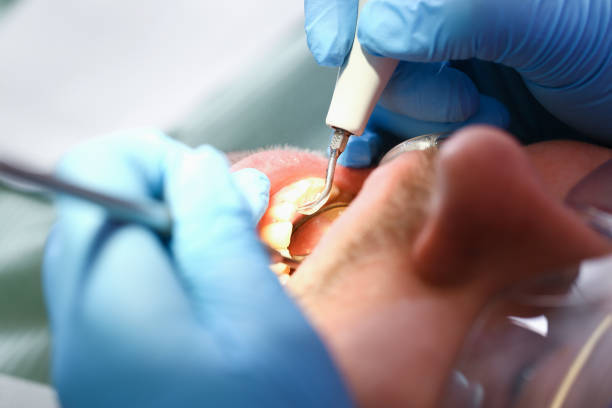 Best Emergency Tooth Extraction in Kokomo, IN