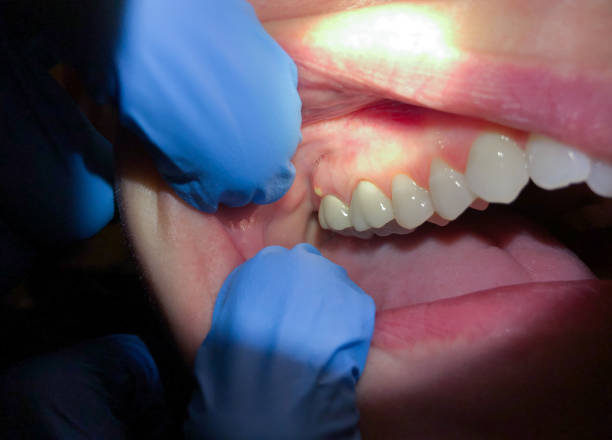 Best Emergency Denture Repair in Kokomo, IN