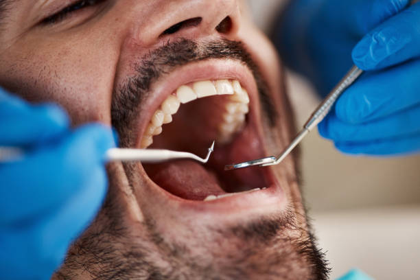 Best Emergency Wisdom Teeth Removal in Kokomo, IN
