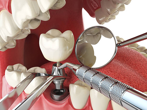 Best Emergency Root Canal Treatment in Kokomo, IN